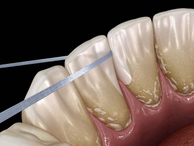 Dental plaque, with the initial step being the adhesion of bacteria to dental surfaces, is the etiologic factor for periodontitis. Dental plaque is in the form of a bio-film and is difficult to eliminate completely. Currently, the treatment of periodontitis is based on mechanical removal of the biofilm by scaling, root planing, and adjunctive use of antibiotics. The problem with this approach is that the bio-film formation is stubborn and persistent–it restarts immediately after the mechanical cleaning has finished, and antibiotics cannot and should not be used continuously. Though periodontal pathogens communicate through quorum sensing, new approaches to treating periodontal disease using quorum sensing inhibition must be explored.